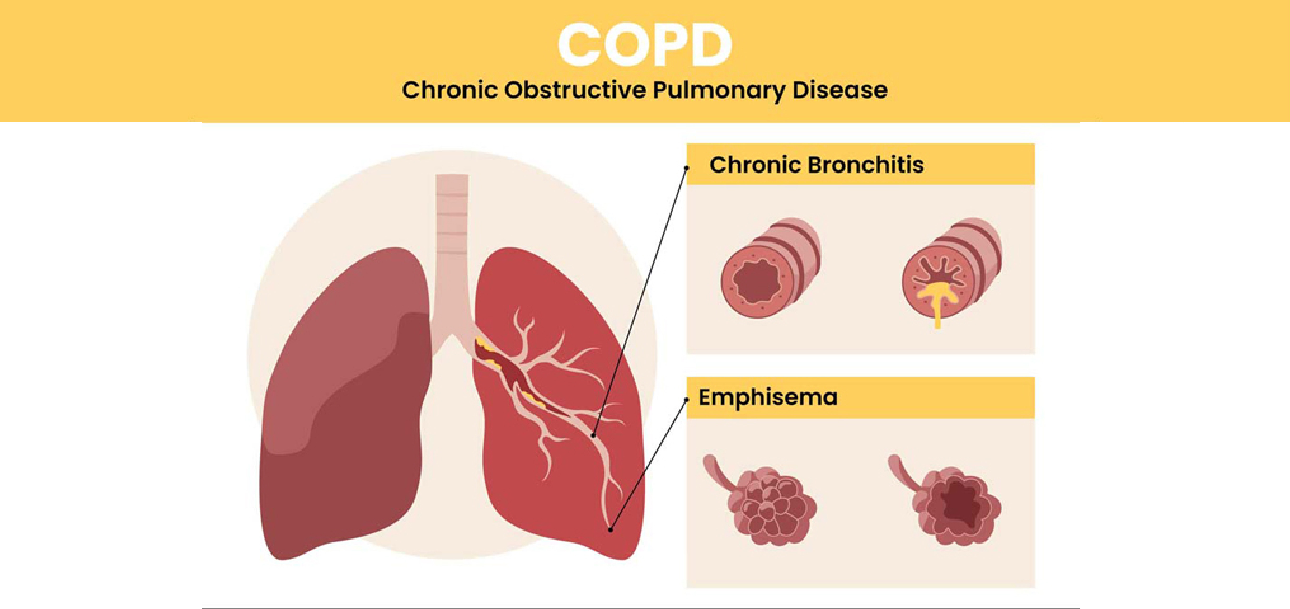 COPD (Chronic Obstructive Pulmonary Disease): An Overview