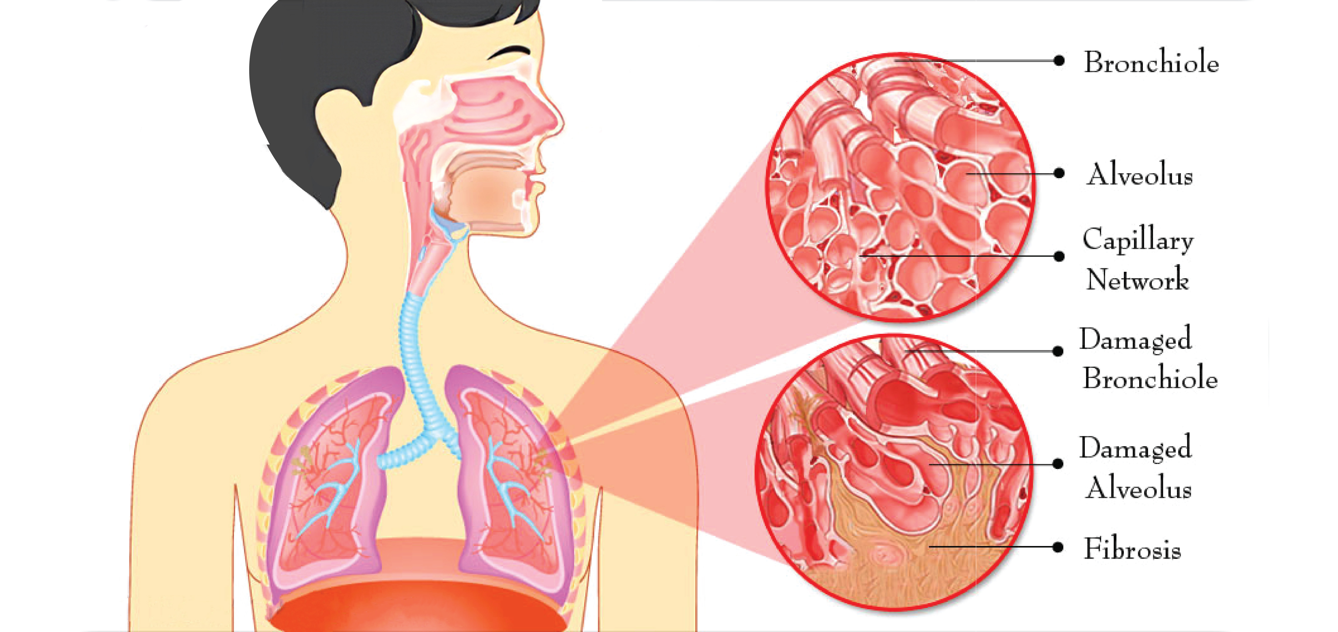 pulmonary fibrosis